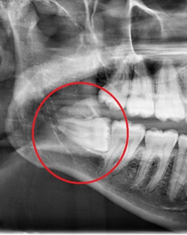 Impacted Wisdom Tooth X-Ray