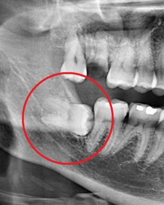 Impacted Wisdom Tooth X-Ray