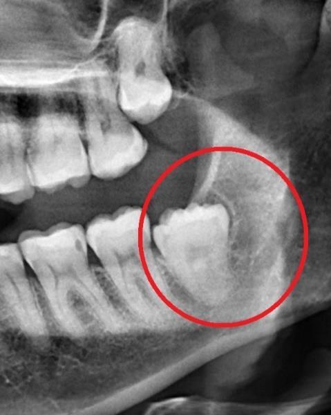 Impacted Wisdom Tooth X-Ray