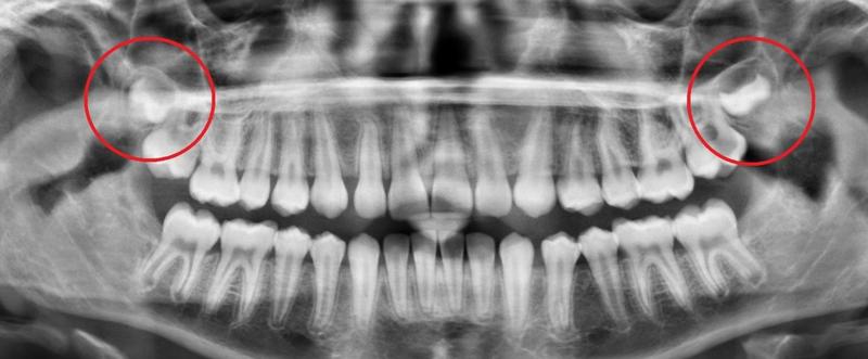 Wisdom Teeth X-Ray