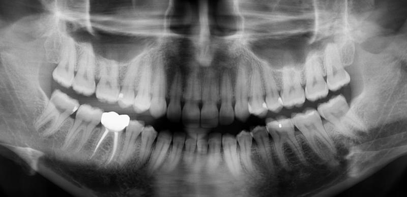 Wisdom Teeth X-Ray