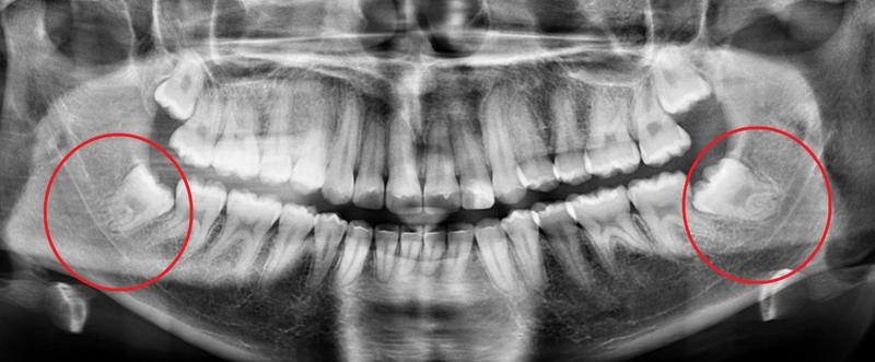 Wisdom Teeth X-Ray