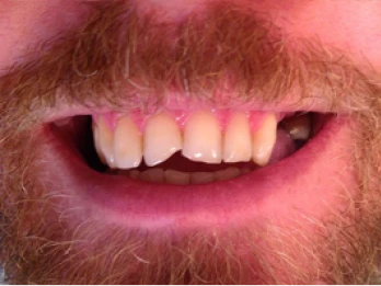 Man with a broken front tooth.