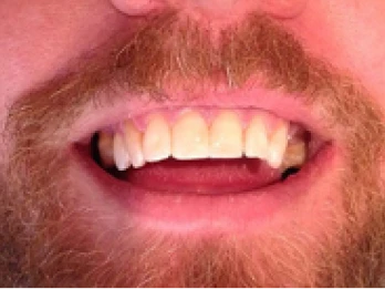 Man with restored front teeth.