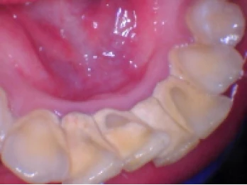 Severely worn lower teeth.