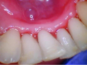 Restored lower teeth after dental treatment.