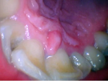 Decayed and damaged molars with gum issues.