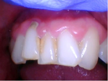 Damaged front tooth with gum inflammation.