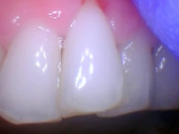 Restored tooth with a dental crown.