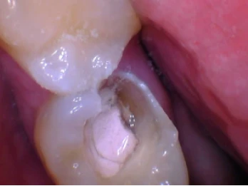 Severely decayed molar with exposed pulp.