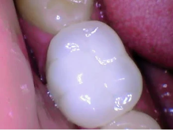 Restored molar with a dental crown.