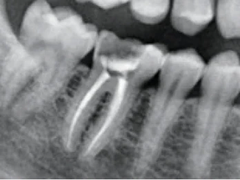 X-ray of a molar with a root canal and crown.