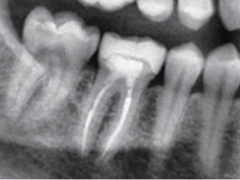 X-ray of a completed root canal treatment.