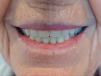 Close-up of an elderly person’s smile with dental work.