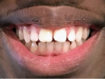 Close-up of a person smiling with slightly uneven teeth.