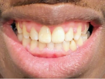 Close-up of a person smiling with straight teeth.