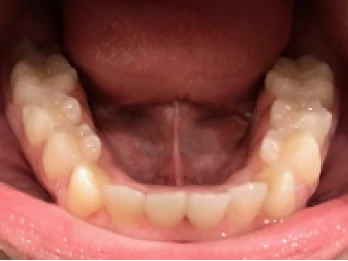 Lower dental arch showing aligned teeth.