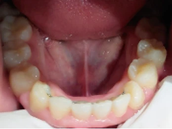 Lower dental arch with a bonded retainer.