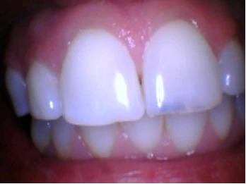 Close-up of front teeth with discoloration.