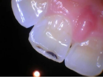 Close-up of a tooth with visible decay.