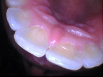 Inside view of upper front teeth.